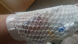 アレルギー 歯周病 ポケット 埋没型：親不知 親知らず 抜歯手術 入院 麻酔 静脈 全身 不安 痛い 腫れ 抗生物質 点滴