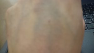 アレルギー 歯周病 ポケット 埋没型：親不知 親知らず 抜歯手術 入院 麻酔 静脈 全身 不安 痛い 腫れ 抗生物質 点滴