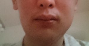 アレルギー 歯周病 ポケット 埋没型：親不知 親知らず 抜歯手術 入院 麻酔 静脈 全身 不安 痛い 腫れ 抗生物質 点滴