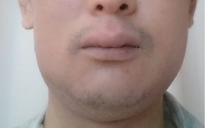 アレルギー 歯周病 ポケット 埋没型：親不知 親知らず 抜歯手術 入院 麻酔 静脈 全身 不安 痛い 腫れ 抗生物質 点滴