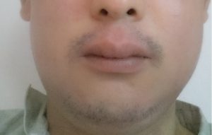 アレルギー 歯周病 ポケット 埋没型：親不知 親知らず 抜歯手術 入院 麻酔 静脈 全身 不安 痛い 腫れ 抗生物質 点滴